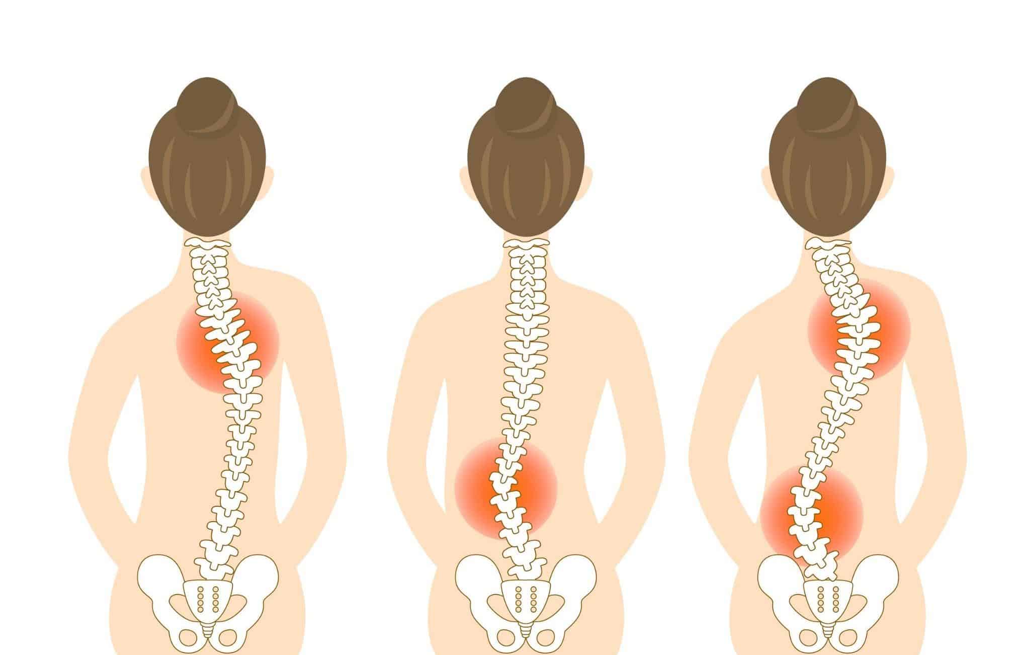 What Happens If You Don’t Correct Your Scoliosis?